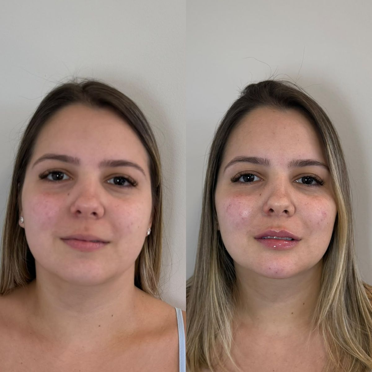 Antes e depois de preenchimento labial com resultado natural